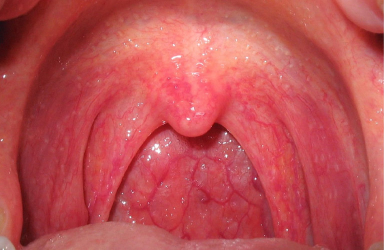 Viêm họng là bệnh lý thường gặp ở trẻ nhỏ