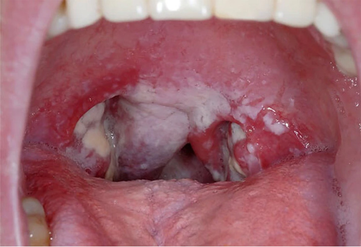 Cổ họng đau, đỏ với các mảng trắng là biểu hiện đặc trưng của tình trạng viêm họng do liên cầu khuẩn