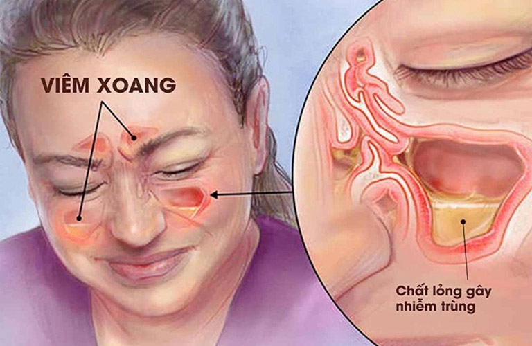 Viêm xoang nghẹt mũi là một biểu hiện lâm sàng phổ biến của bệnh viêm mũi xoang