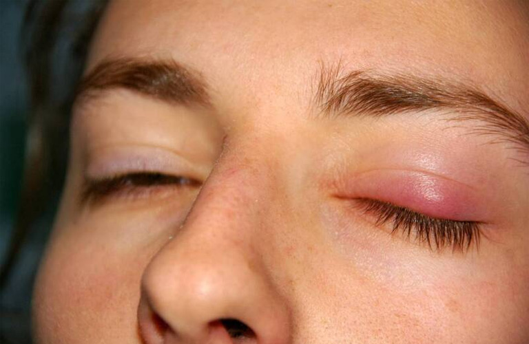 Viêm nhiễm ở xoang mũi kéo dài có thể gây viêm mí mắt