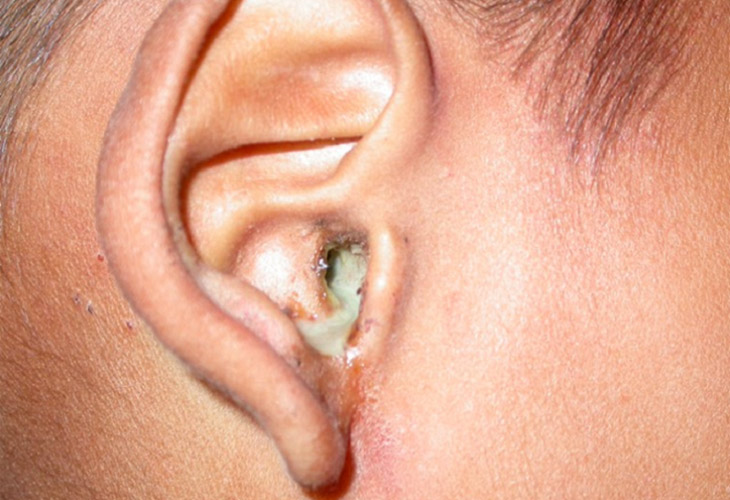 Viêm tai giữa chảy mủ được phân loại rõ ràng giúp điều trị hiệu quả