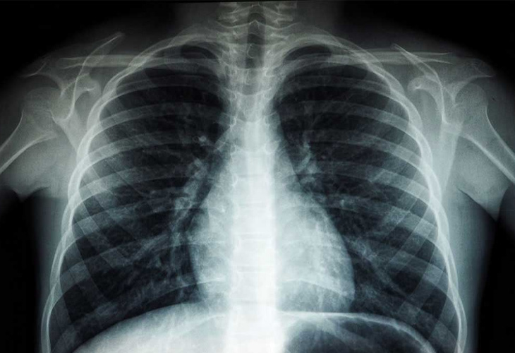 X-quang phổi giúp loại trừ các bệnh lý phổi