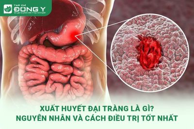 xuất huyết đại tràng