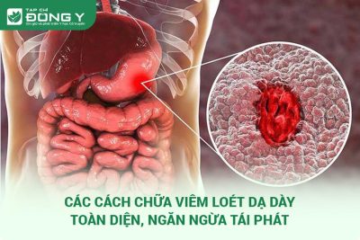 chữa viêm loét dạ dày